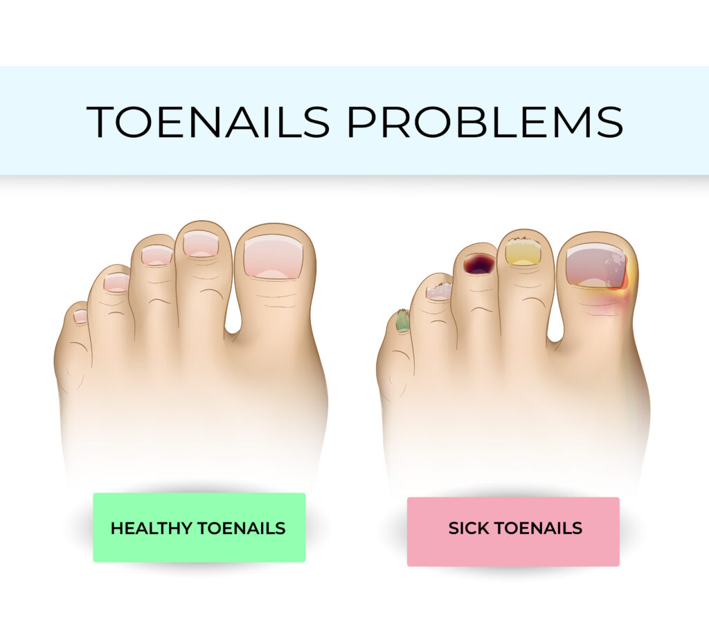 What Kills Toenail Fungus Instantly