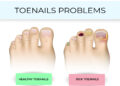 What Kills Toenail Fungus Instantly