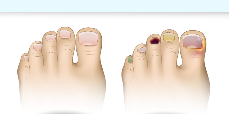 What Kills Toenail Fungus Instantly