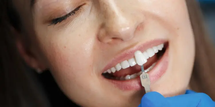 dental veneers for missing teeth